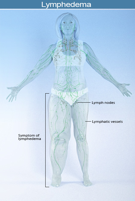 Lymphedema, Lymphatic Obstruction