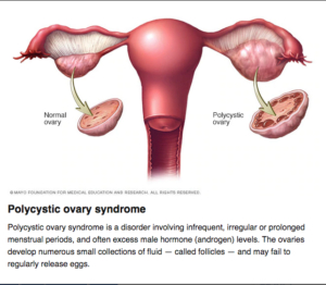 polycystic ovarian syndrome