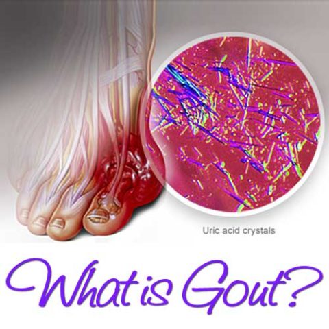 Learning About Gout | Wellness Works NW