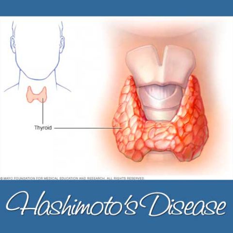 Learning About Hashimoto’s Disease | Wellness Works NW